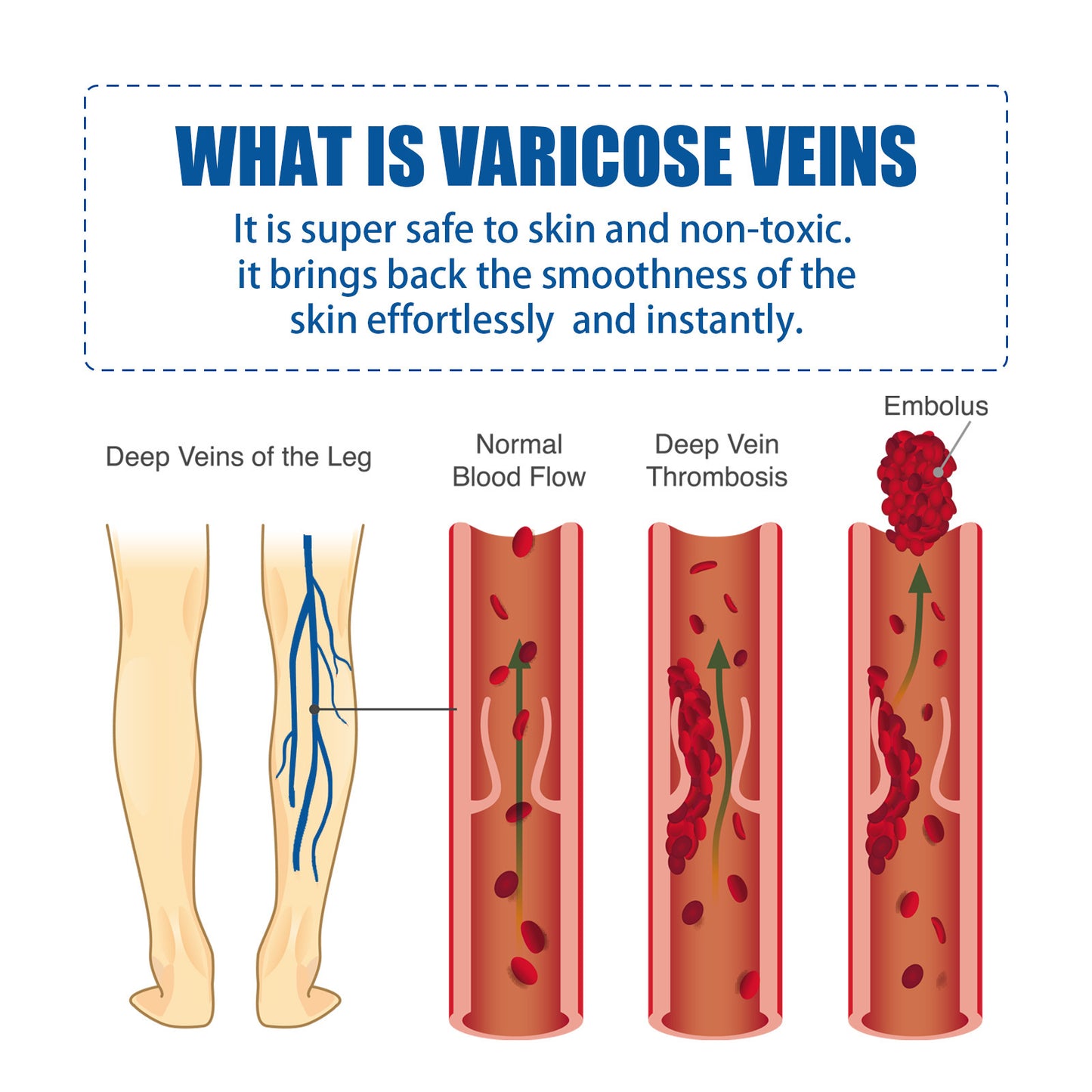 Intravenous Massage Cream Relieves Vascular Leg Massage Treatment